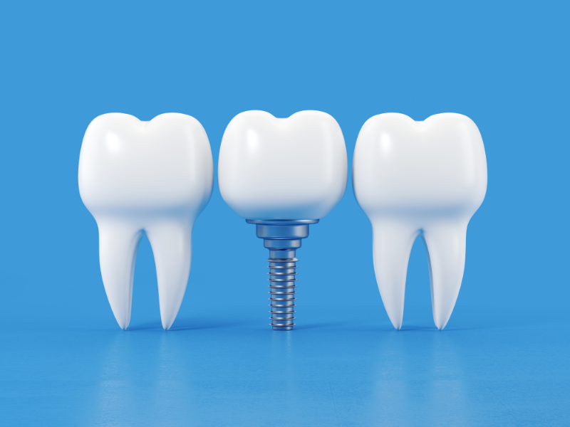 implanty zębowe1